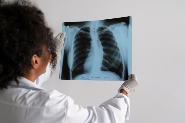 Vaksin Tuberkolosis Mulaina di Uji Coba, Ini Gelaja TBC yang Perlu Dipahami 