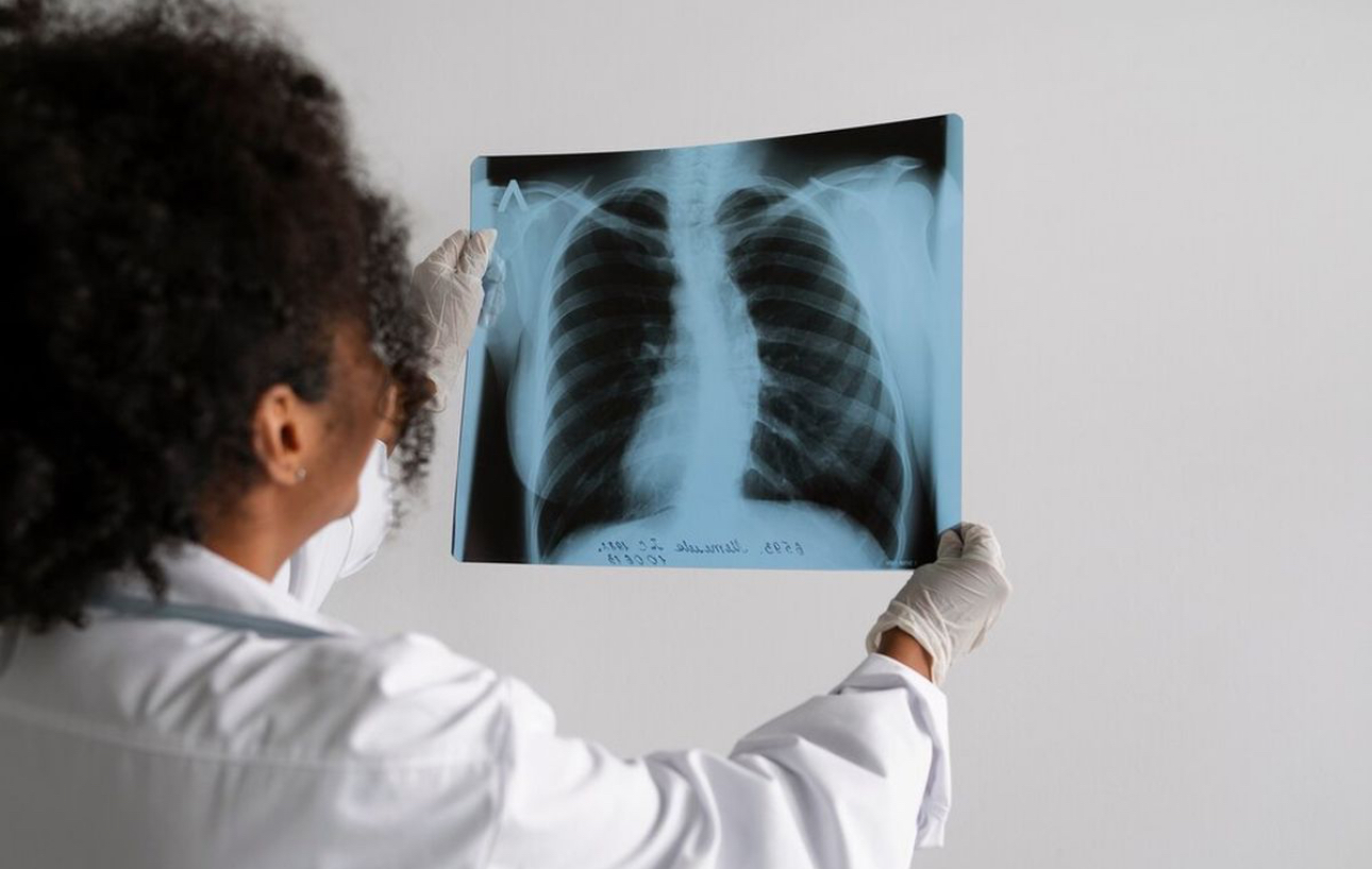 Vaksin Tuberkolosis Mulaina di Uji Coba, Ini Gelaja TBC yang Perlu Dipahami 