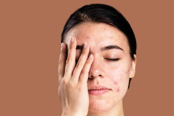 Penyebab Menggunakan Sunscreen Pada Malam Hari, Bisa Timbulkan Jerawat